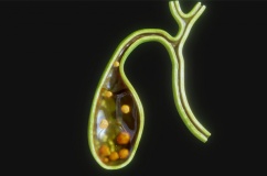 Có sỏi túi mật 21mm dùng TPBVSK Kim Đởm Khang được không?