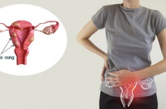 U xơ tử cung có gây hiếm muộn không?