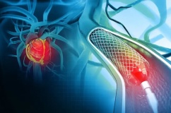 Sau can thiệp đặt stent mạch vành: Bao lâu có thể làm việc trở lại?