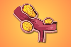 Xơ vữa động mạch: Nguyên nhân, mức độ nguy hiểm và giải pháp hỗ trợ phòng ngừa