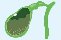 Có polyp túi mật và sỏi bùn túi mật cần cẩn trọng gì?