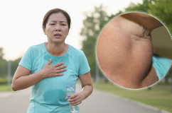 Khả năng vận động suy giảm vì bướu cổ do thiếu iod