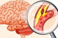 Những ai dễ bị nhồi máu não?