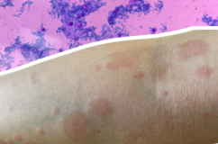 Lupus ban đỏ dạng đĩa ảnh hưởng thế nào đến cơ thể và làn da?