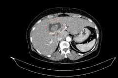 Phát hiện mắc đồng thời 2 bệnh ung thư nguy hiểm từ dấu hiệu vàng da