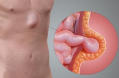 Làm thế nào để tự đánh giá nguy cơ mắc thoát vị?