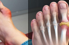 Bệnh gout cấp có chữa khỏi được không?