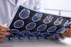 3 yếu tố làm tăng nguy cơ tử vong do bệnh đa xơ cứng