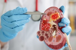 Sỏi thận có tự đào thải không?