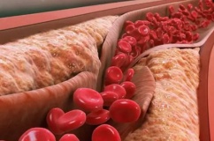 Xơ vữa động mạch hình thành như thế nào?  