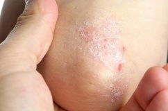 Cây sói rừng - thảo dược hỗ trợ cải thiện bệnh vảy nến hiệu quả