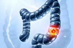 5 dấu hiệu ung thư đại tràng phổ biến dễ bị bỏ qua