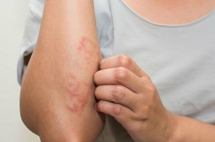 Viêm mao mạch dị ứng ở trẻ em có nguy hiểm không?