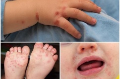 Sốt xuất huyết và tay chân miệng cùng gia tăng mạnh