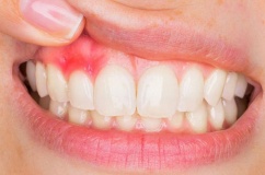 Mách bạn 5 cách cải thiện viêm lợi tại nhà