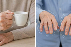 Cách phân biệt run do tuổi tác và run bệnh lý