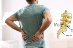 Triệu chứng cảnh báo thoát vị đĩa đệm lưng không nên bỏ qua
