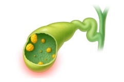 Polyp túi mật 14mm có nguy hiểm không?