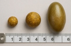 Sỏi mật 9,6mm có nguy hiểm không?