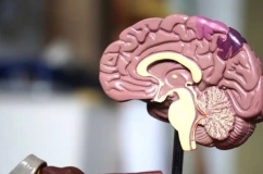 Tai biến mạch máu não ảnh hưởng đến não phải và não trái ra sao?