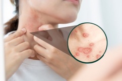 Lupus ban đỏ dạng đĩa có nguy hiểm không? 