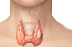 Bướu cổ đơn thuần có nguy hiểm không?