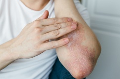 Nguyên nhân nào khiến vảy nến lan ra toàn thân?