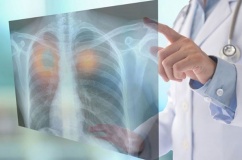 Dấu hiệu nhận biết u phổi lành tính và ác tính