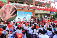 Bộ Y tế cảnh báo gia tăng bệnh tay chân miệng trong mùa tựu trường