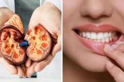 Từ chảy máu chân răng đến nguy cơ tổn thương thận