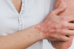 Những hiểu lầm khiến người bệnh vảy nến thêm tự ti