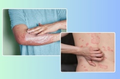 Mẹo chăm sóc da cho người bệnh vảy nến thể mảng