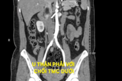 Tình cờ phát hiện u thận kèm huyết khối tĩnh mạch chủ