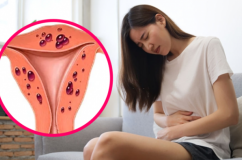 Vì sao lạc nội mạc tử cung thuờng được phát hiện muộn?