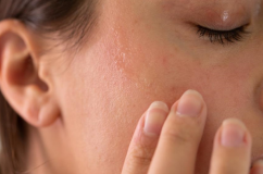 5 nguyên nhân khiến da vẫn khô dù dưỡng ẩm thường xuyên