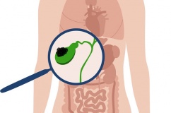 Đa polyp túi mật 9x8mm nên xử trí thế nào?