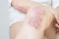 Chủ động kiểm soát vảy nến từ sớm để không lo bệnh bùng phát khi trời lạnh