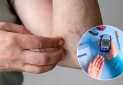 Người bệnh đái tháo đường bị ngứa da, càng gãi càng ngứa có nguy hiểm không?