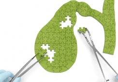 Sau phẫu thuật cắt túi mật, dùng TPBVSK Kim Đởm Khang được không?