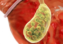 Có đám sỏi mật 27mm phải làm sao?