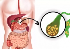Sỏi túi mật 7,5mm có nguy hiểm không?