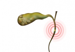 Có sỏi ống mật chủ 36x12mm: Dùng TPBVSK Kim Đởm Khang được không?