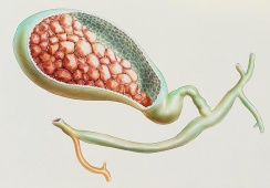 Sỏi mật 8,9mm và 15mm chưa có biến chứng có nguy hiểm không?