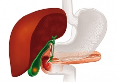 Sỏi mật 25mm dùng TPBVSK Kim Đởm Khang được không?