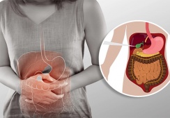 Có 3 viên sỏi mật 8mm dùng TPBVSK Kim Đởm Khang được không?