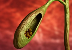 Sỏi túi mật 4,5mm dùng TPBVSK Kim Đởm Khang được không?