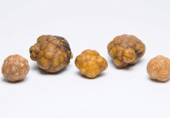 Sỏi mật 39mm nguy hiểm tới thế nào?