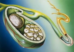 Tại sao đã mổ lấy sỏi mật 13mm vẫn tái phát sau 6 tháng?