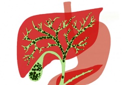 Sỏi gan 7,5mm nên mổ hay dùng cách tẩy sỏi gan 1 ngày?