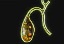 Có sỏi túi mật 21mm dùng TPBVSK Kim Đởm Khang được không?